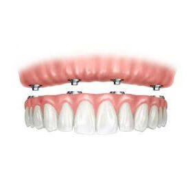 Implantes